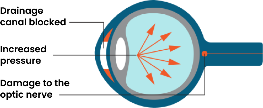 What happens to the eye with glaucoma.